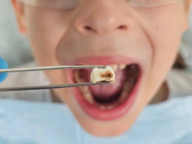 Best Dentist for Tooth Abscess  in Cambridge, NE